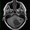 2A2 Astrocytoma, pilocytic (Case 2) T1 - Copy