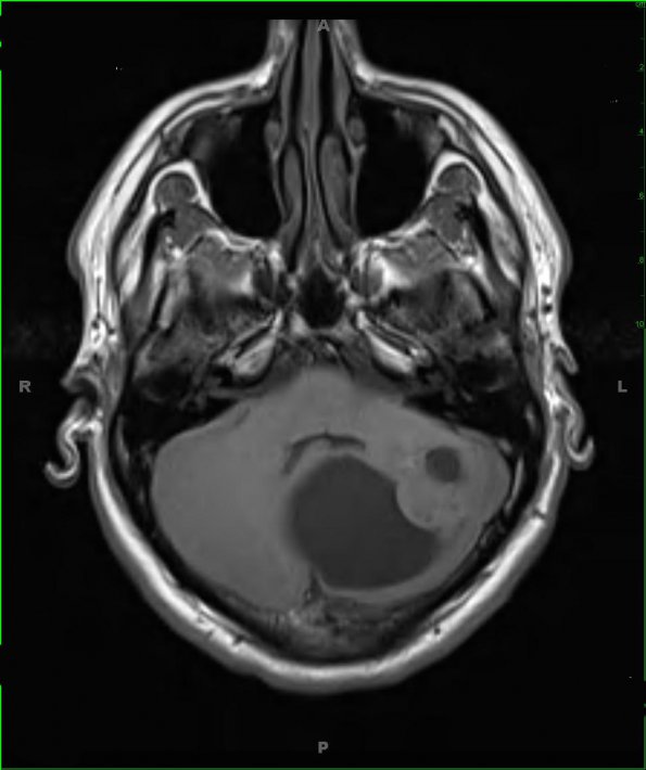 2A2 Astrocytoma, pilocytic (Case 2) T1 - Copy