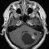 2A3 Astrocytoma, pilocytic (Case 2) T1 W 3 - Copy