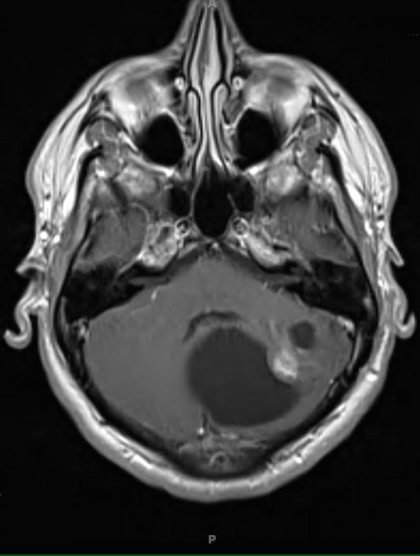 2A3 Astrocytoma, pilocytic (Case 2) T1 W 3 - Copy