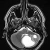 2A4 Astrocytoma, pilocytic (Case 2) T2 - Copy