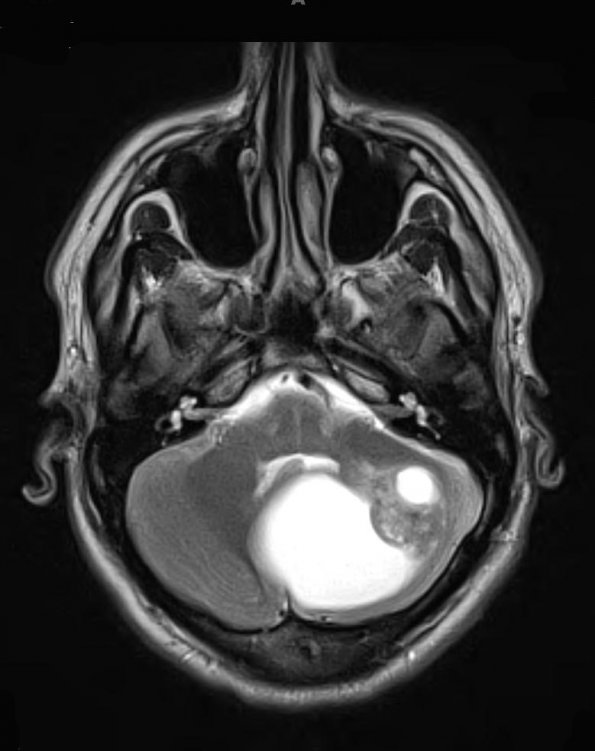 2A4 Astrocytoma, pilocytic (Case 2) T2 - Copy