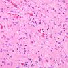 2B1 Astrocytoma, pilocytic (Case 2) H&E 3