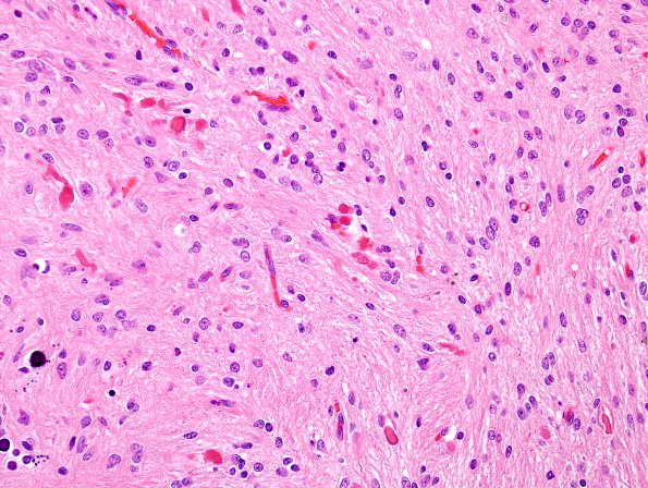 2B1 Astrocytoma, pilocytic (Case 2) H&E 3