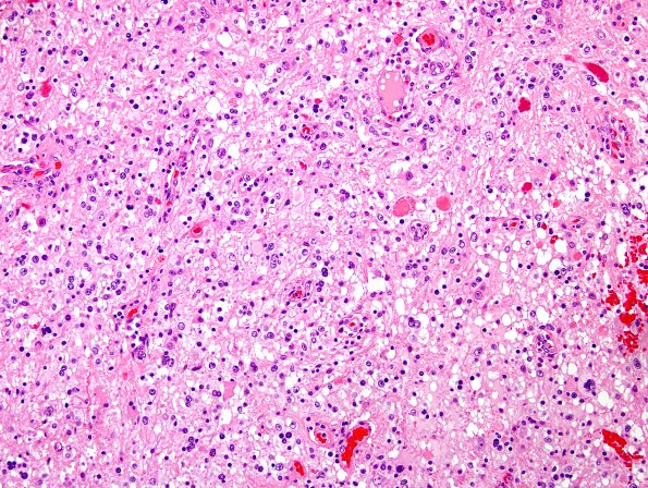 2B2 Astrocytoma, pilocytic (Case 2) H&E 6