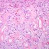 2B3 Astrocytoma, pilocytic (Case 2) H&E 2