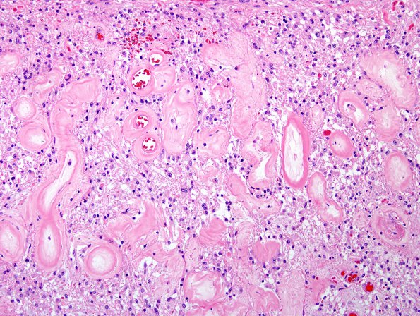 2B3 Astrocytoma, pilocytic (Case 2) H&E 2