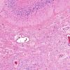 2B4 Astrocytoma, pilocytic (Case 2) H&E 10X