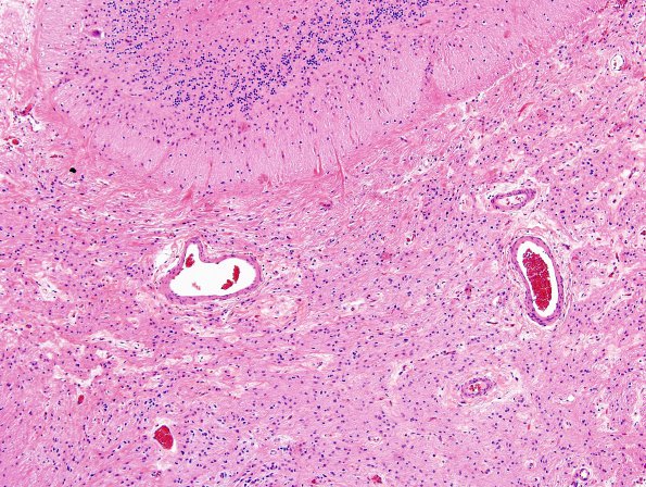 2B4 Astrocytoma, pilocytic (Case 2) H&E 10X