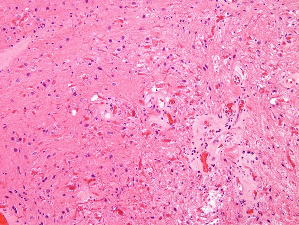 30A Astrocytoma, pilocytic (Case 30) H&E 2