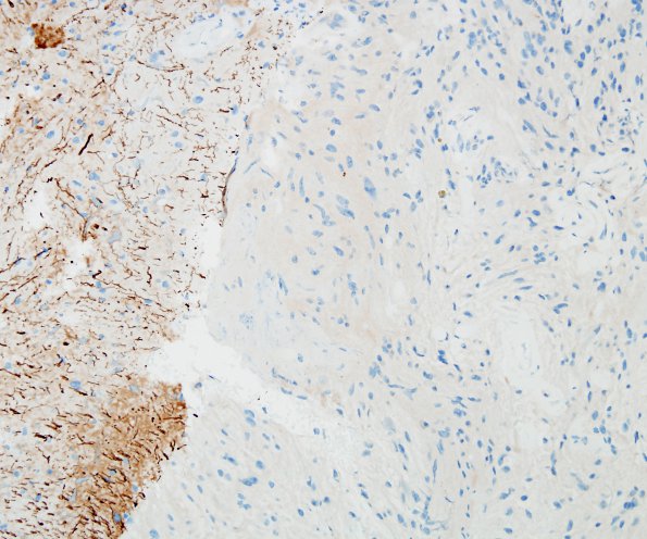 30C Astrocytoma, pilocytic (Case 30) NF 2