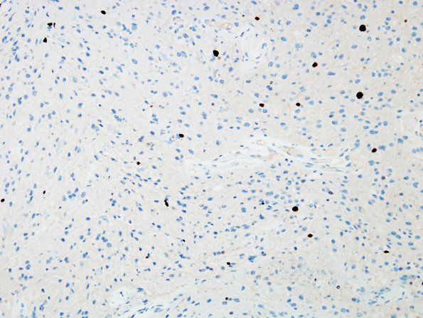 30D Astrocytoma, pilocytic (Case 30) Ki67