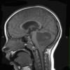 31A1 Astrocytoma, pilocytic (Case 31) T1 1 - Copy