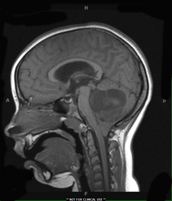 31A1 Astrocytoma, pilocytic (Case 31) T1 1 - Copy