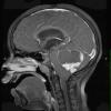 31A2 Astrocytoma, pilocytic (Case 31) T1 W - Copy