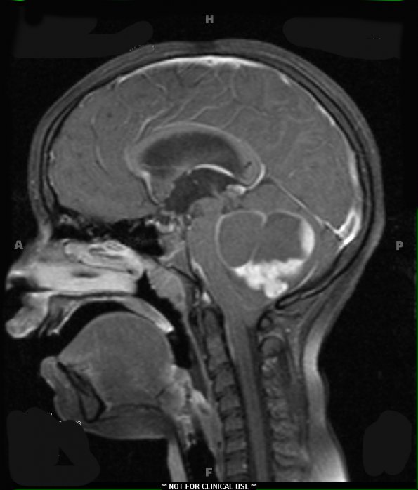 31A2 Astrocytoma, pilocytic (Case 31) T1 W - Copy