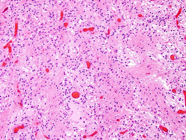 31B1 Astrocytoma, pilocytic (Case 31) H&E 11