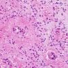 31B2 Astrocytoma, pilocytic (Case 31) H&E 13