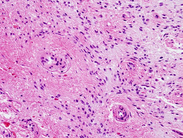 31B2 Astrocytoma, pilocytic (Case 31) H&E 13