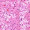 31B3 Astrocytoma, pilocytic (Case 31) H&E 8