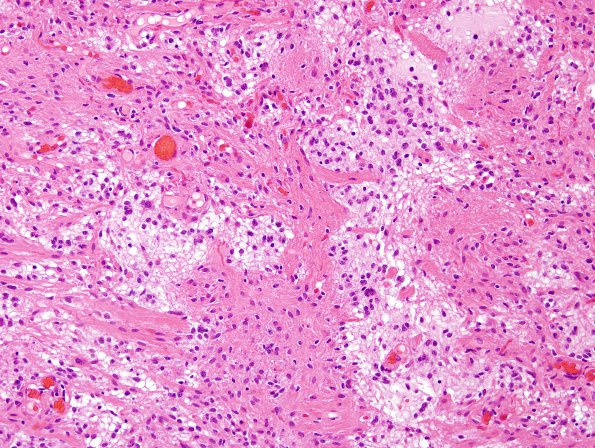 31B3 Astrocytoma, pilocytic (Case 31) H&E 8