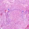 31B4 Astrocytoma, pilocytic (Case 31) H&E 4 copy