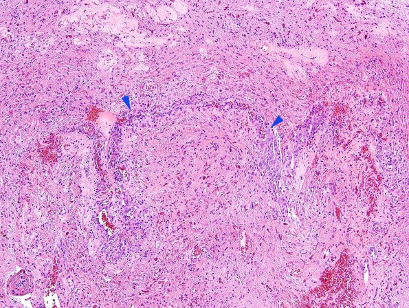 31B4 Astrocytoma, pilocytic (Case 31) H&E 4 copy