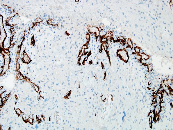 31B5 Astrocytoma, pilocytic (Case 31) CD34