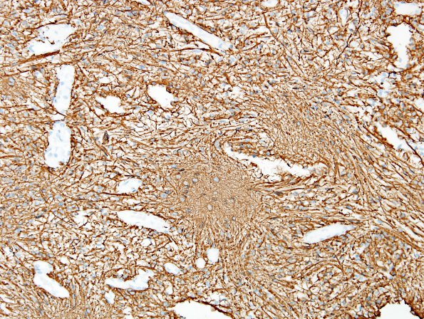 31C Astrocytoma, pilocytic (Case 31) GFAP 2