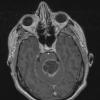 32A1 Astrocytoma, pilocytic RX (Case 32) T1 W - Copy