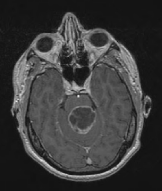 32A1 Astrocytoma, pilocytic RX (Case 32) T1 W - Copy