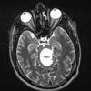 32A2 Astrocytoma, pilocytic RX (Case 32 T2 W - Copy