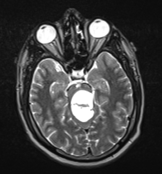 32A2 Astrocytoma, pilocytic RX (Case 32 T2 W - Copy