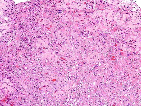 32B1 Astrocytoma, pilocytic RX (Case 32 H&E 1