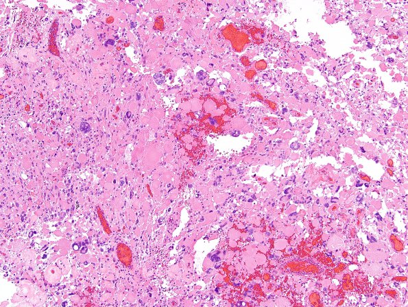 32B2 Astrocytoma, pilocytic RX (Case 32 H&E 3