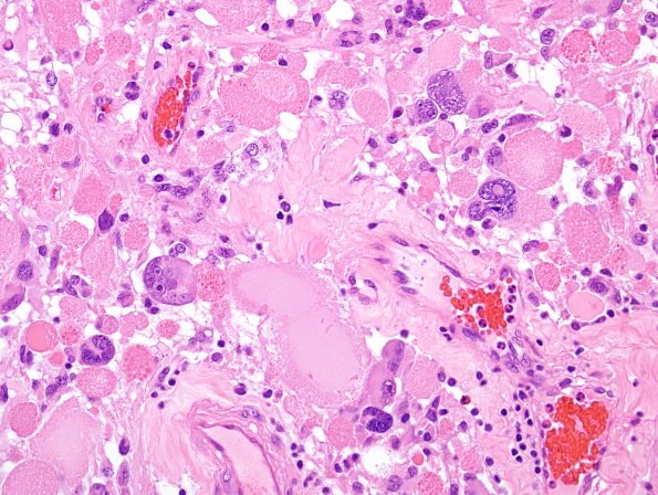 32B3 Astrocytoma, pilocytic RX (Case 32 H&E 7