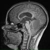 33A Astrocytoma, pilocytic (Case 33) MPRAGE T1 - Copy