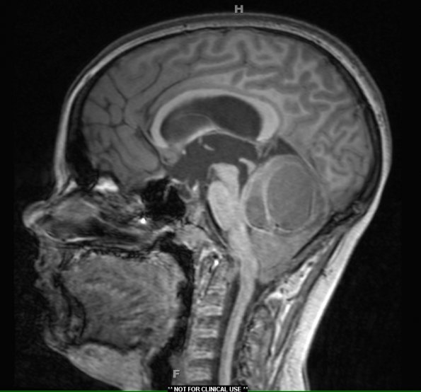 33A Astrocytoma, pilocytic (Case 33) MPRAGE T1 - Copy