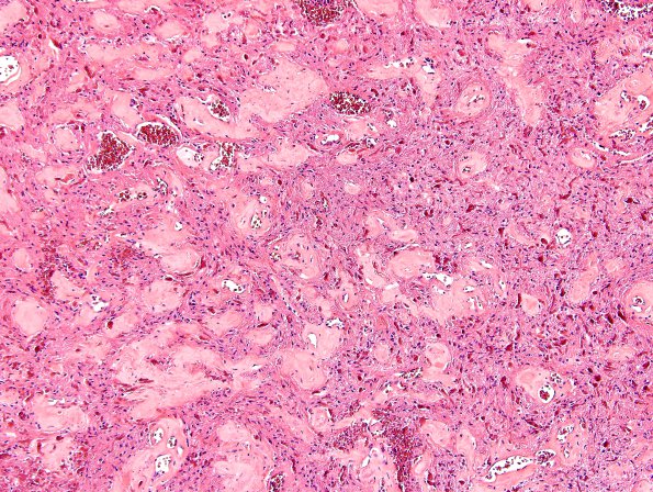 33B Astrocytoma, pilocytic (Case 33) H&E 2