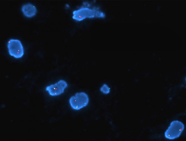 33C Astrocytoma, pilocytic (Case 33) KIAA-BRAF