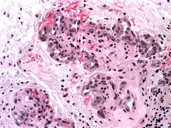 34A Astrocytoma, pilocytic (Case 34) H&E