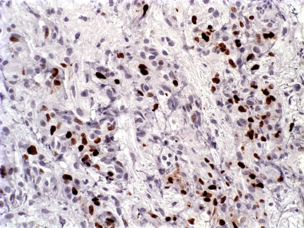 34B Astrocytoma, pilocytic (Case 34) MIB