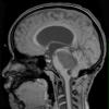 35A1 Astrocytoma, pilocytic (Case 35) T1 - Copy