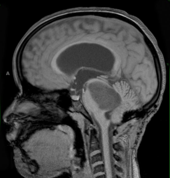 35A1 Astrocytoma, pilocytic (Case 35) T1 - Copy