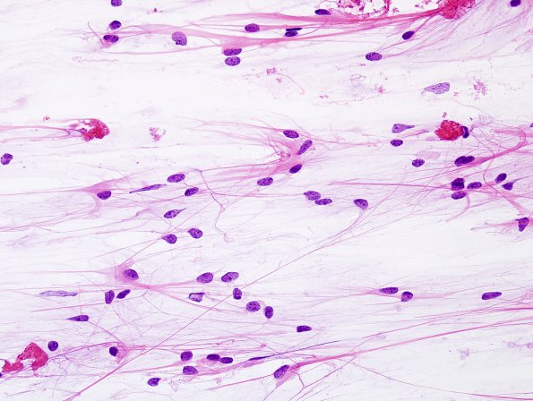 35B1 Astrocytoma, pilocytic (Case 35) H&E 2