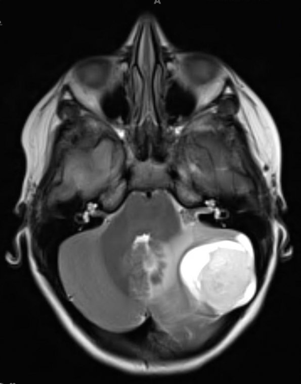 36A Astrocytoma, pilocytic, atypical (Case 36) T2 - Copy