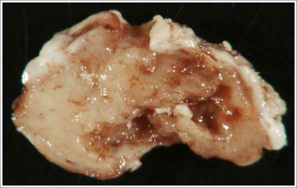 36B Astrocytoma, pilocytic, atypical (Case 36) 2