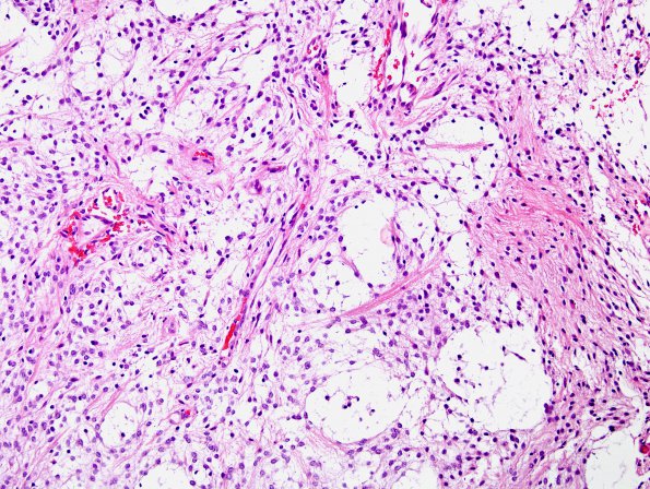 36C1 Astrocytoma, pilocytic, atypical, Case 36) H&E 4