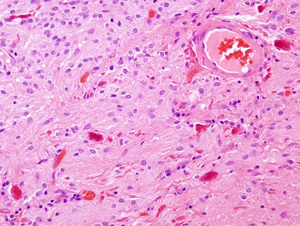 36C2 Astrocytoma, pilocytic, atypical, (Case 36) H&E 1