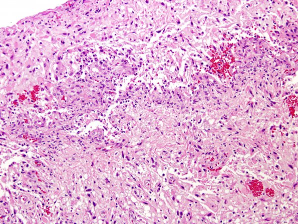 37A Astrocytoma, pilocytic (Case 37) H&E 2